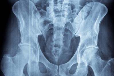 X-ray imaging test for ankylosing spondylitis.