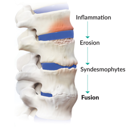 Image of a spine showing phases of back pain.